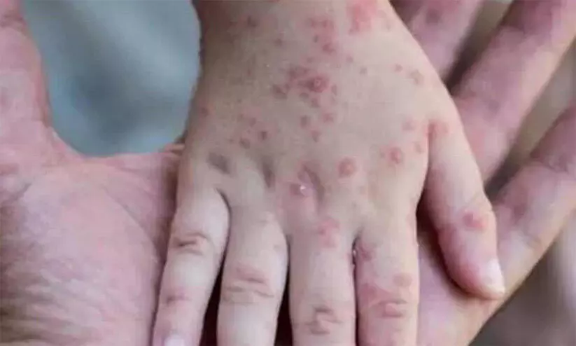 monkey pox monkey pox