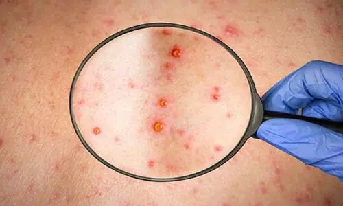 വാനര വസൂരി: വിമാനത്താവളങ്ങളിൽ ഹെൽപ് ഡെസ്ക്