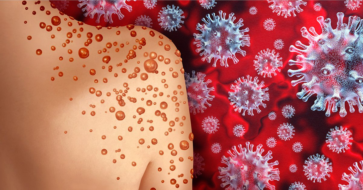 വാനര വസൂരി; കേന്ദ്ര സംഘമെത്തി; പ്രതിരോധ നടപടികളിൽ സംതൃപ്തി വാനര വസൂരി; കേന്ദ്ര സംഘമെത്തി; പ്രതിരോധ നടപടികളിൽ സംതൃപ്തി