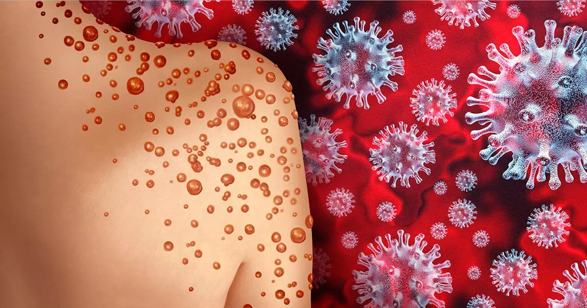 വാനര വസൂരി; കേന്ദ്ര സംഘമെത്തി; പ്ര​തി​രോ​ധ ന​ട​പ​ടി​ക​ളി​ൽ സം​തൃ​പ്തി