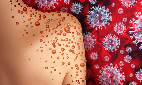 വാനര വസൂരി: മെഡിക്കൽ കോളജിൽ പ്രത്യേക വാർഡൊരുക്കി