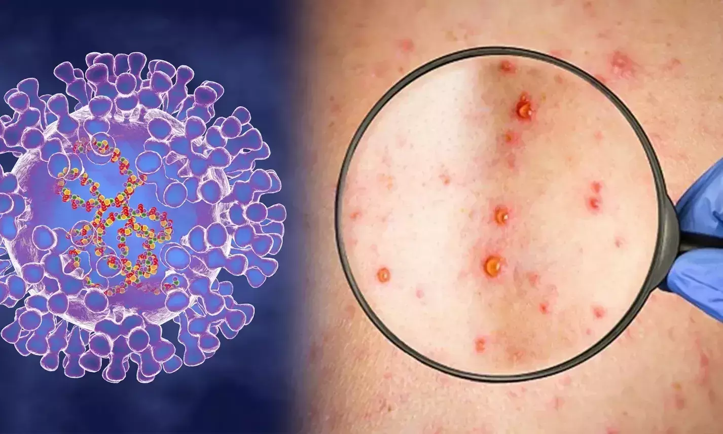 ജില്ലയിൽ മങ്കി പോക്സ്: മുൻകരുതൽ നടപടികളുമായി ആരോഗ്യവകുപ്പ്