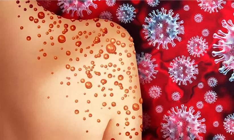 Monkey Pox Monkey Pox