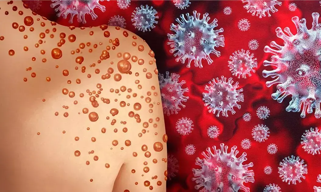 70 രാജ്യങ്ങളിലായി 14,000 വാനര വസൂരി കേസുകൾ