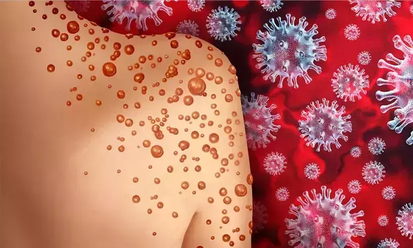 കുരങ്ങ് വസൂരിയെ ഭയക്കേണ്ടതില്ലെന്ന് ആരോഗ്യ വിദഗ്ധർ