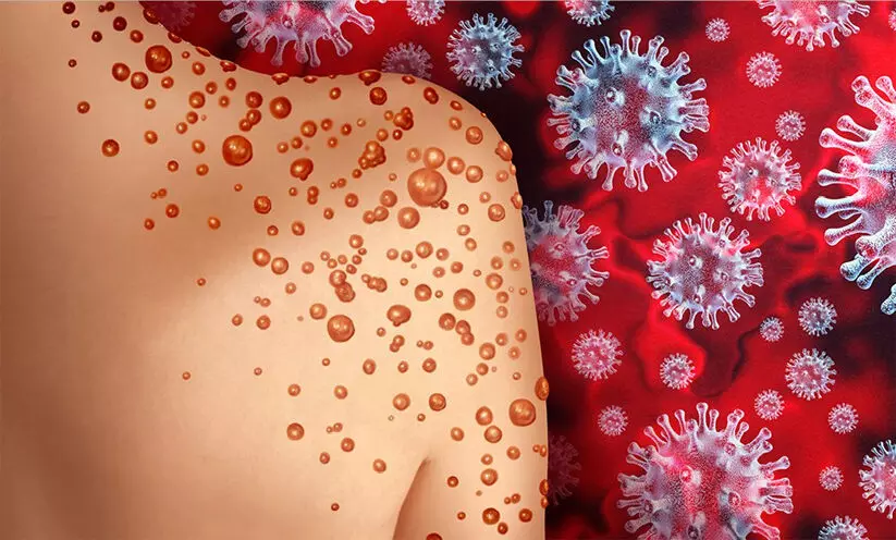 മങ്കിപോക്സ്: വാക്സിൻ നൽകാൻ ഇപ്പോൾ പദ്ധതിയില്ലെന്ന് ഇന്ത്യ