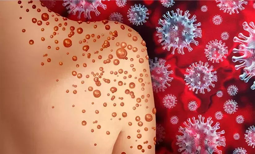 മങ്കിപോക്സ്: വാക്സിൻ നൽകാൻ ഇപ്പോൾ പദ്ധതിയില്ലെന്ന് ഇന്ത്യ