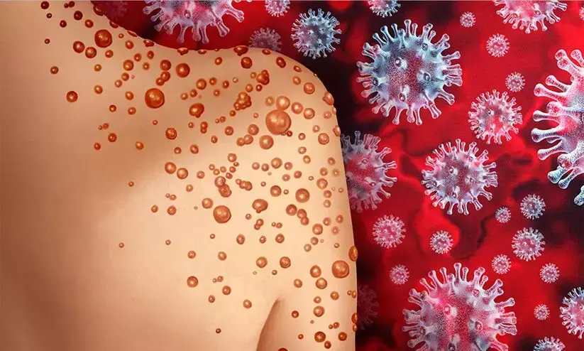 നിപക്ക് പിന്നാലെ മങ്കിപോക്സും; മെഡിക്കൽ കോളജിൽ അതിജാഗ്രത