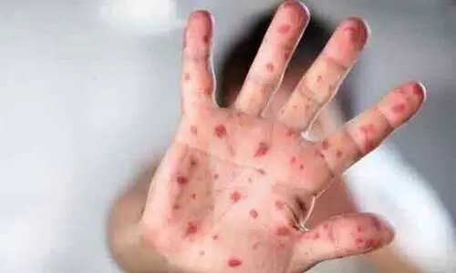 വാനര വസൂരി: കേരളവും അതിജാഗ്രതയിലേക്ക്​