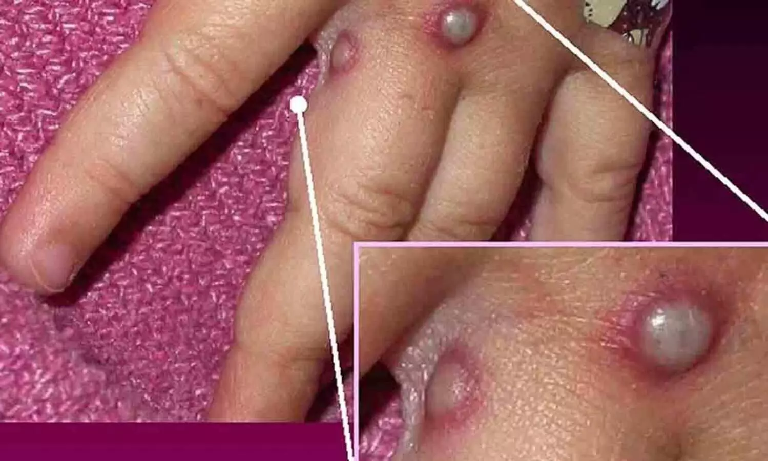 ഡൽഹിയിൽ വാനര വസൂരി ബാധിച്ചയാൾ ബാച്ചിലർ പാർട്ടിയിൽ പ​ങ്കെടുത്തുവെന്ന് കണ്ടെത്തൽ