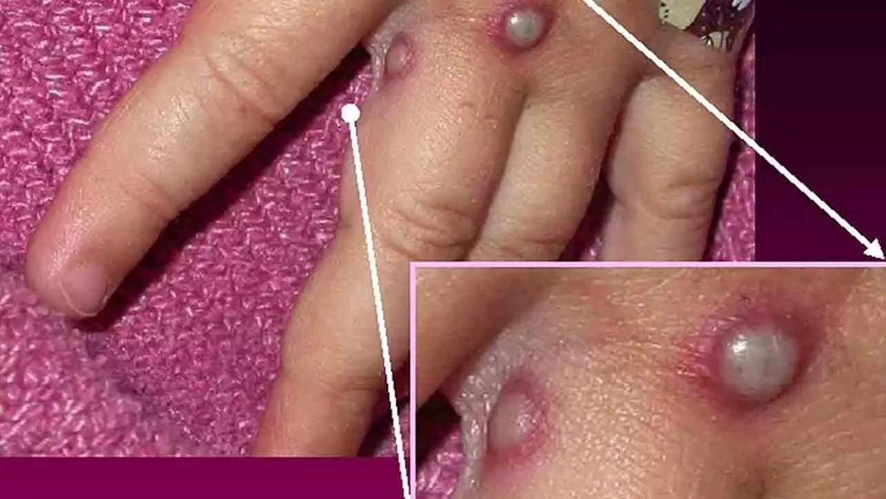 ഡൽഹിയിൽ വാനര വസൂരി ബാധിച്ചയാൾ ബാച്ചിലർ പാർട്ടിയിൽ പ​ങ്കെടുത്തുവെന്ന് കണ്ടെത്തൽ