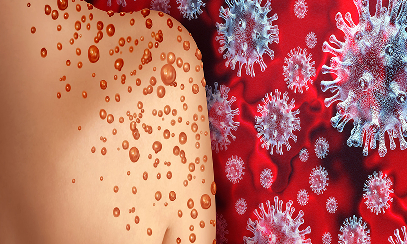 വാനരവസൂരി; ജാഗ്രത നിർദേശം വാനരവസൂരി; ജാഗ്രത നിർദേശം