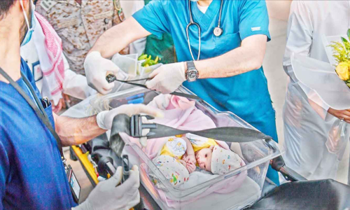 യമനി സയാമീസുകളുടെ വേർപെടുത്തൽ ശസ്ത്രക്രിയ ഇന്ന്