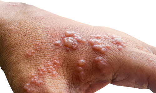 വാനര വസൂരി ലക്ഷണങ്ങളോടെ മരണം: യുവാവിന്റെ സമ്പർക്ക പട്ടികയിലുള്ള 15 പേർ നിരീക്ഷണത്തിൽ