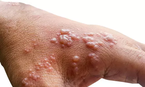 വാനര വസൂരി ലക്ഷണങ്ങളോടെ മരണം: യുവാവിന്റെ സമ്പർക്ക പട്ടികയിലുള്ള 15 പേർ നിരീക്ഷണത്തിൽ