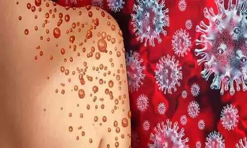 കുരഞ്ഞിയൂരിൽ വാനര വസൂരിമൂലം യുവാവ് മരിച്ച സംഭവം; സമ്പർക്കമുണ്ടായ നാല് പേരെ കുറിച്ച് വ്യക്തതയില്ല