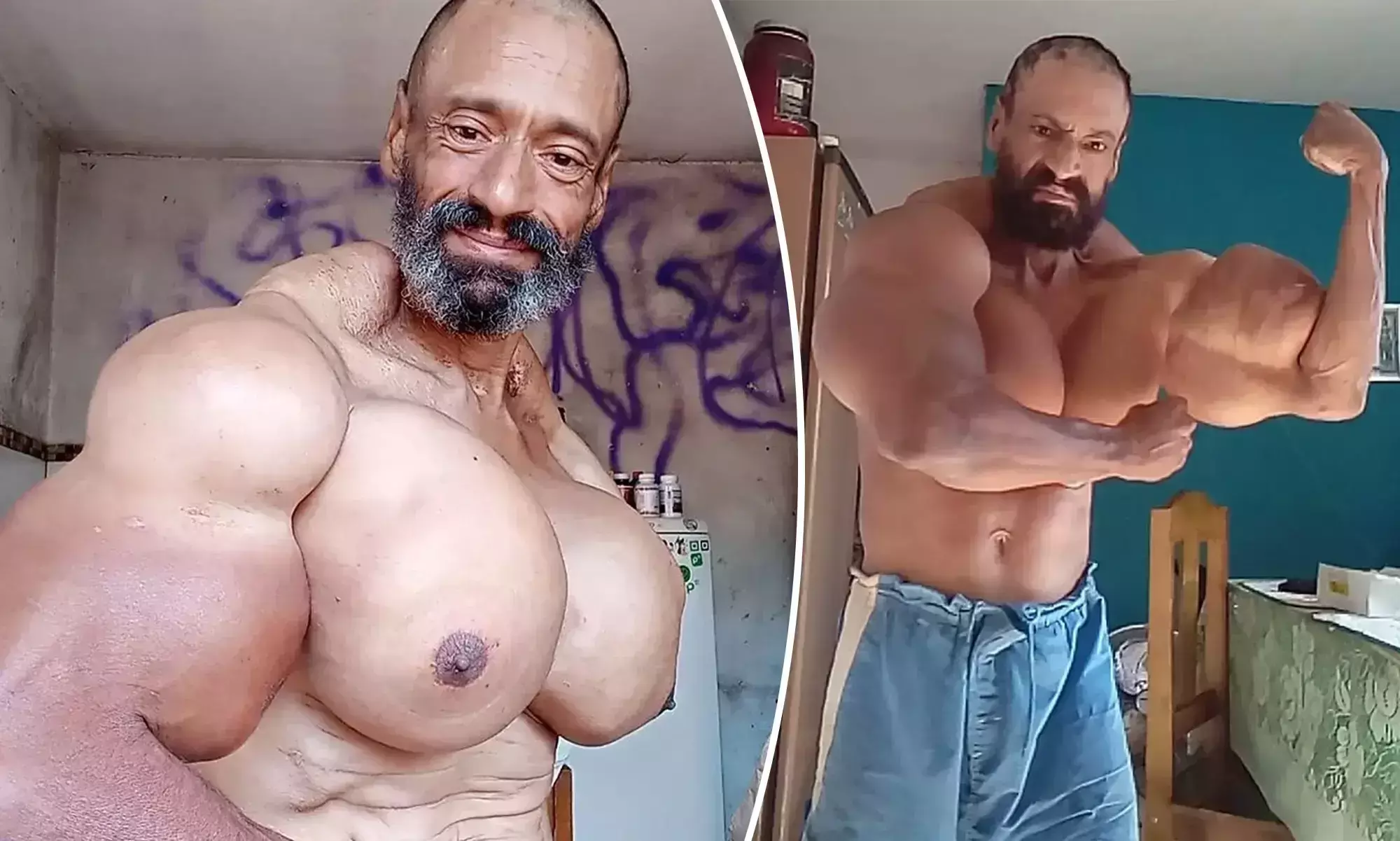 ഹൾക്കിനെപോലെയാവാൻ മരുന്ന് കുത്തിവെച്ചയാൾക്ക് 55ാം പിറന്നാൾ ദിനത്തിൽ ദാരുണാന്ത്യം