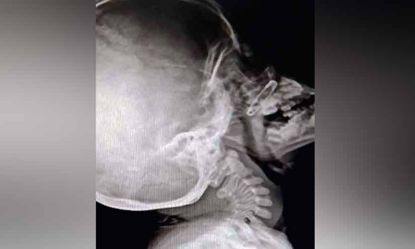 അഞ്ചുവയസ്സുകാരന്റെ മൂക്കിൽ എട്ടുമാസം മുമ്പ് കുടുങ്ങിയ പിൻ പുറത്തെടുത്തു അഞ്ചുവയസ്സുകാരന്റെ മൂക്കിൽ എട്ടുമാസം മുമ്പ് കുടുങ്ങിയ പിൻ പുറത്തെടുത്തു