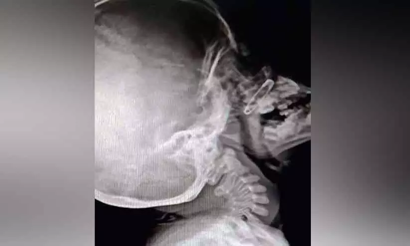 അഞ്ചുവയസ്സുകാരന്‍റെ മൂക്കിൽ എട്ടുമാസം മുമ്പ് കുടുങ്ങിയ പിൻ പുറത്തെടുത്തു