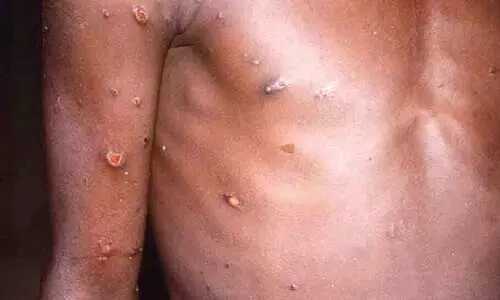 വാനരവസൂരി: വ്യാപനം തടയാൻ മാർഗ്ഗനിർദ്ദേശം പുറത്തിറക്കി ആരോഗ്യമന്ത്രാലയം