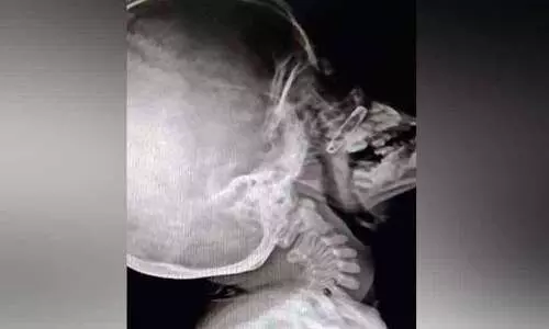 അഞ്ചുവയസ്സുകാരന്‍റെ മൂക്കിൽ എട്ടുമാസം മുമ്പ് കുടുങ്ങിയ പിൻ പുറത്തെടുത്തു