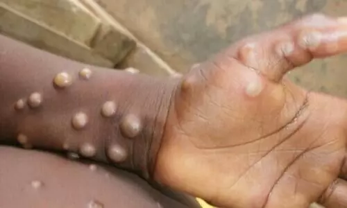 വാനര വസൂരി ലക്ഷണം; ജിദ്ദയിൽ നിന്നെത്തിയയാളെ ആശുപത്രിയിലേക്ക് മാറ്റി