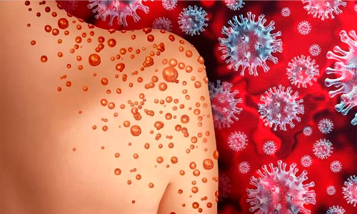 മങ്കി പോക്സ് സംശയിച്ച് ആശുപത്രിയിൽ പ്രവേശിപ്പിച്ചയാൾ മുങ്ങി