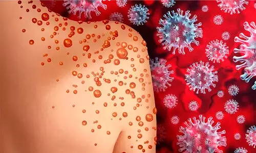 വാനര വസൂരി; ഉന്നതാധികാര യോഗം വിളിച്ച് കേന്ദ്രം