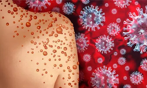 മങ്കിപോക്സ്: രണ്ടാമത്തെ രോഗി രോഗമുക്തി നേടി മങ്കിപോക്സ്: രണ്ടാമത്തെ രോഗി രോഗമുക്തി നേടി