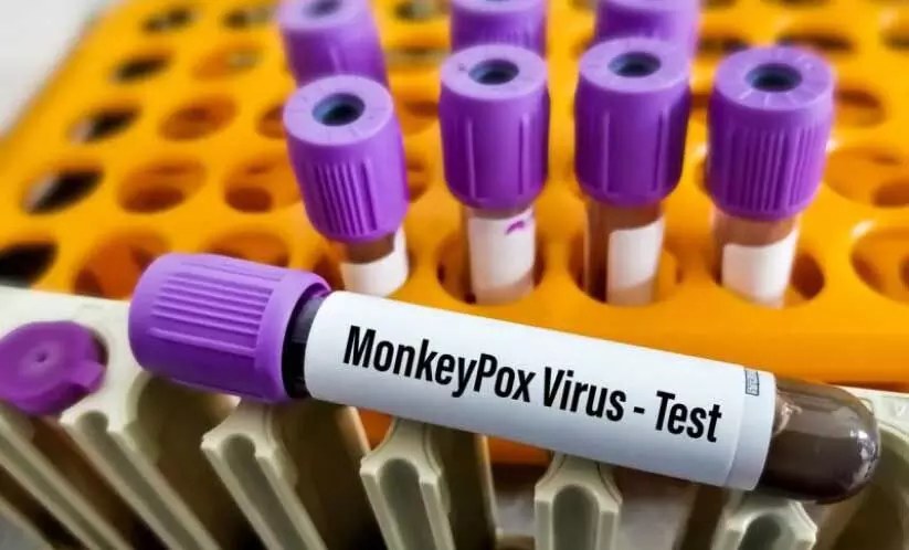 മങ്കിപോക്സ്: സമൂഹം കുറ്റപ്പെടുത്തുന്നത് ഭയന്ന്  സ്വവർഗാനുരാഗികൾ ടെസ്റ്റ് നടത്താൻ മടിക്കുന്നു