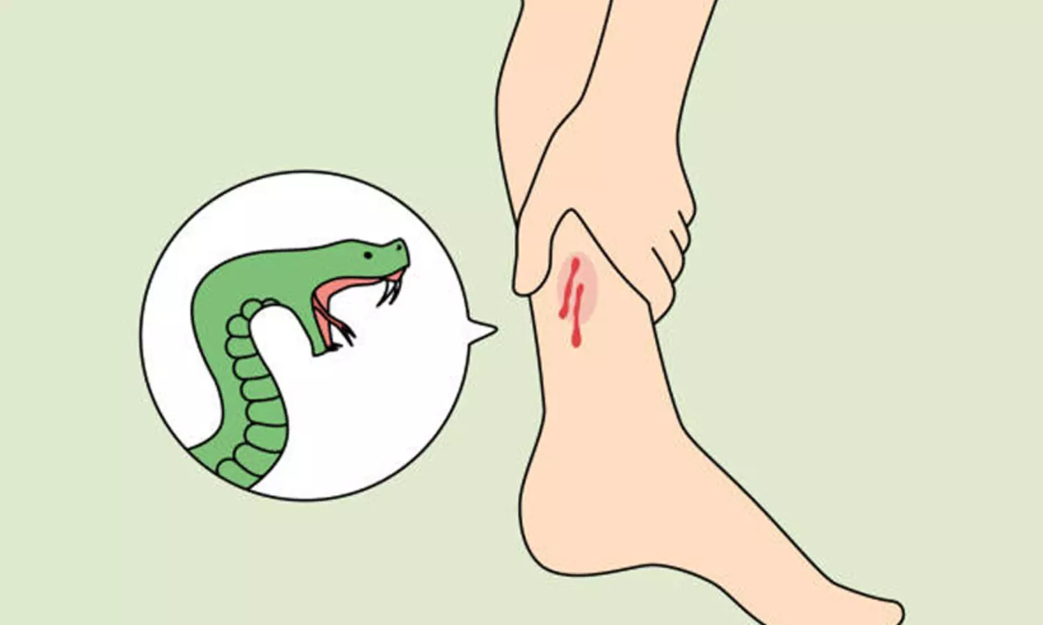 snake bite