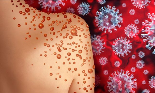 വാനരവസൂരി; ഏഴുവയസ്സുള്ള കുട്ടിയുടെ പരിശോധനഫലം ഇന്ന് ലഭിച്ചേക്കും