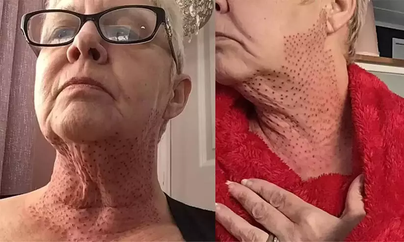 അയഞ്ഞ ചർമം മുറുക്കാൻ സൗന്ദര്യ ശസ്ത്രക്രിയ; സ്ത്രീയുടെ കഴുത്ത് ഇപ്പോൾ പല്ലിയുടേത് പോലെ! അയഞ്ഞ ചർമം മുറുക്കാൻ സൗന്ദര്യ ശസ്ത്രക്രിയ; സ്ത്രീയുടെ കഴുത്ത് ഇപ്പോൾ പല്ലിയുടേത് പോലെ!