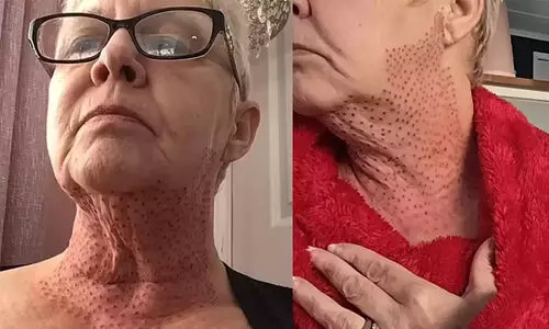 അയഞ്ഞ ചർമം മുറുക്കാൻ സൗന്ദര്യ ശസ്ത്രക്രിയ; സ്ത്രീയുടെ കഴുത്ത് ഇപ്പോൾ പല്ലിയുടേത് പോലെ!