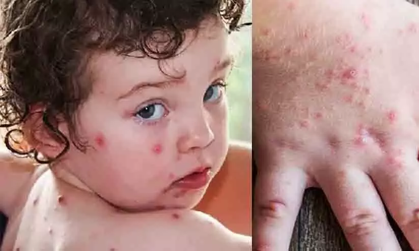 തക്കാളിപ്പനിയിൽ ആശങ്കയുമായി മെഡിക്കൽ വിദഗ്ധർ തക്കാളിപ്പനിയിൽ ആശങ്കയുമായി മെഡിക്കൽ വിദഗ്ധർ