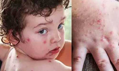 തക്കാളിപ്പനിയി​ൽ ആശങ്കയുമായി മെഡിക്കൽ വിദഗ്ധർ