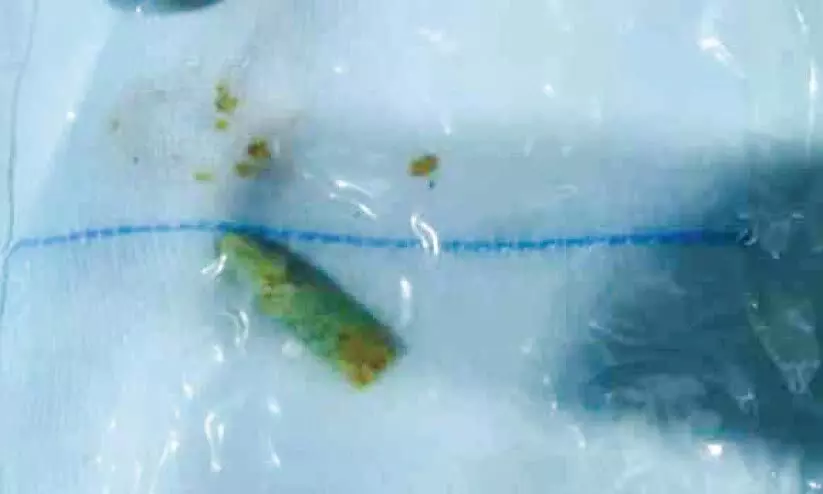 വിഴുങ്ങിയ മെഴുക് പെൻസിൽ പുറത്തെടുത്തു; ഗുരുതരാവസ്ഥ തരണംചെയ്ത് ഒന്നാം ക്ലാസുകാരൻ