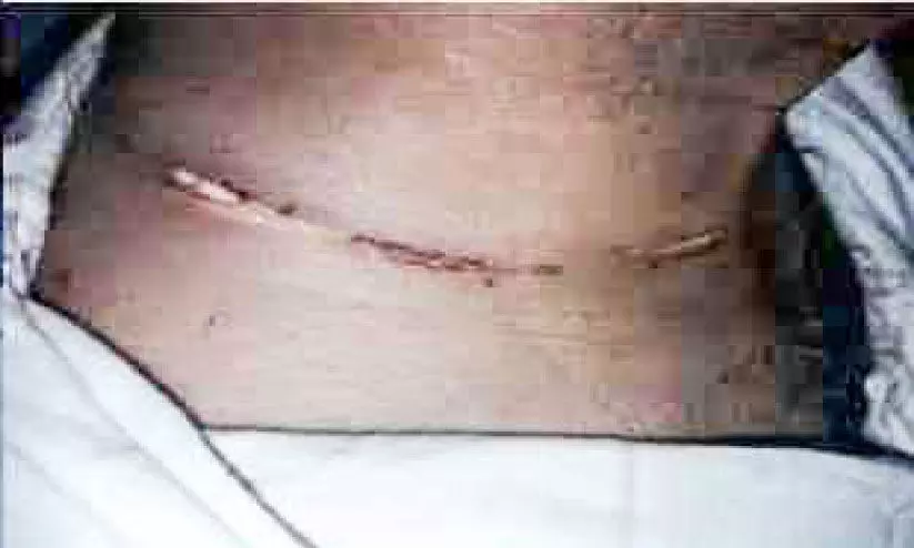 ഇടക്കൊച്ചി പാലത്തിൽ ബൈക്ക് യാത്രികന്റെ കഴുത്തിൽ ടങ്കീസ് കുരുങ്ങി ഇടക്കൊച്ചി പാലത്തിൽ ബൈക്ക് യാത്രികന്റെ കഴുത്തിൽ ടങ്കീസ് കുരുങ്ങി