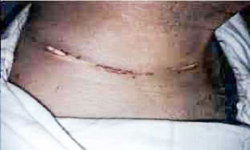 ഇടക്കൊച്ചി പാലത്തിൽ ബൈക്ക് യാത്രികന്റെ കഴുത്തിൽ ടങ്കീസ് കുരുങ്ങി