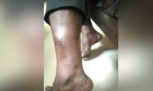 വിമുക്തഭടന്​ തെരുവുനായുടെ കടിയേറ്റു