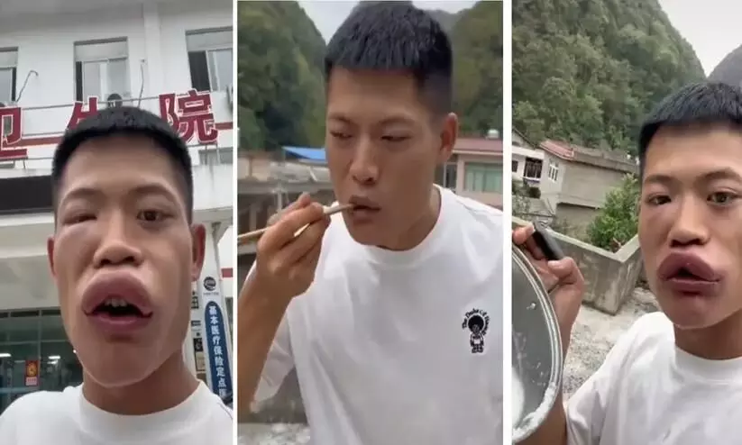 കടന്നലിനെ തിന്നാൻ ശ്രമം; ചൈനീസ് യൂട്യൂബർക്ക് കിട്ടിയത് മുട്ടൻ പണി കടന്നലിനെ തിന്നാൻ ശ്രമം; ചൈനീസ് യൂട്യൂബർക്ക് കിട്ടിയത് മുട്ടൻ പണി