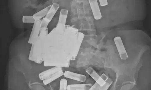 X-ray reveals 55 ingested batteries stuck in a womans GI tract  Picture courtesy: Irish Medical Journal