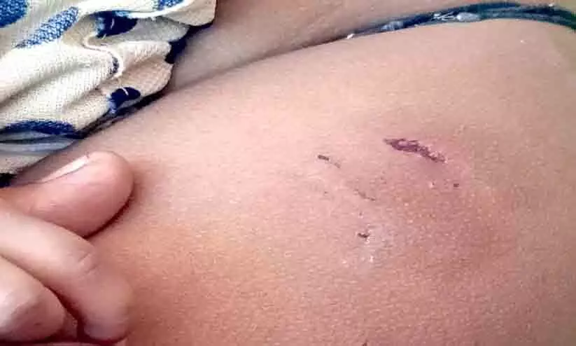 മാതാവിന്‍റെ കൈയിലിരുന്ന ഒന്നര വയസ്സുകാരിയെ തെരുവുനായ് കടിച്ചു