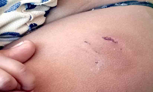 മാതാവിന്‍റെ കൈയിലിരുന്ന ഒന്നര വയസ്സുകാരിയെ തെരുവുനായ് കടിച്ചു