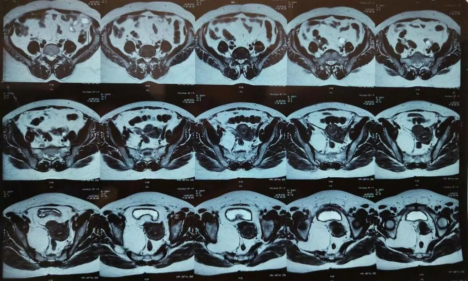 ട്യൂമർ നീക്കാൻ തിരുവനന്തപുരം മെഡിക്കൽ കോളേജിൽ അത്യപൂർവ ശസ്ത്രക്രിയ