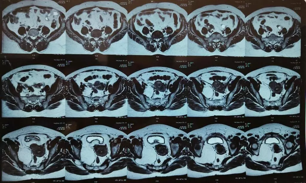 ട്യൂമർ നീക്കാൻ തിരുവനന്തപുരം മെഡിക്കൽ കോളേജിൽ അത്യപൂർവ ശസ്ത്രക്രിയ