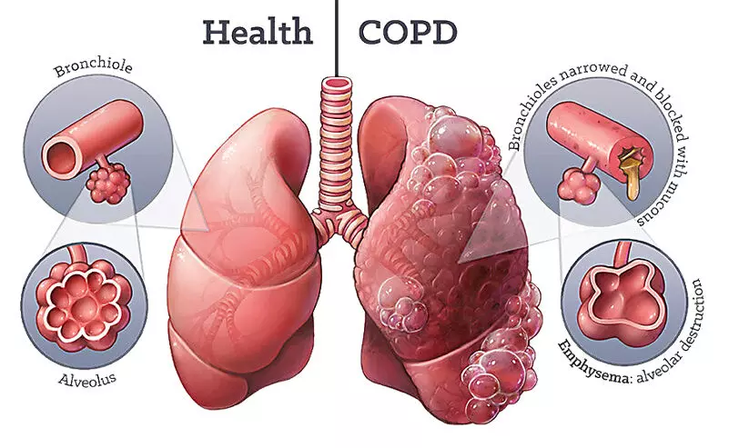 പുക ശ്വസിക്കുന്നവരിലെ സി.ഒ.പി.ഡി അവഗണിക്കരുത്, ചികിത്സ പ്രധാനം പുക ശ്വസിക്കുന്നവരിലെ സി.ഒ.പി.ഡി അവഗണിക്കരുത്, ചികിത്സ പ്രധാനം