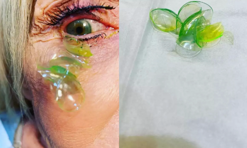 contact lense 097896