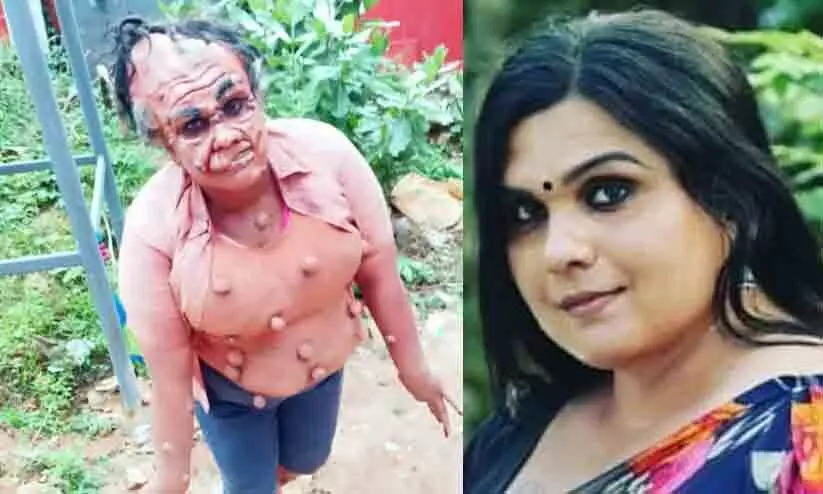 വിഷമഴയുടെ ഇരകളു​ടെ ജീവിതം ആവിഷ്കരിച്ച് കാവ്യ