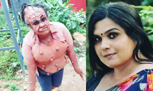 വിഷമഴയുടെ ഇരകളു​ടെ ജീവിതം ആവിഷ്കരിച്ച് കാവ്യ